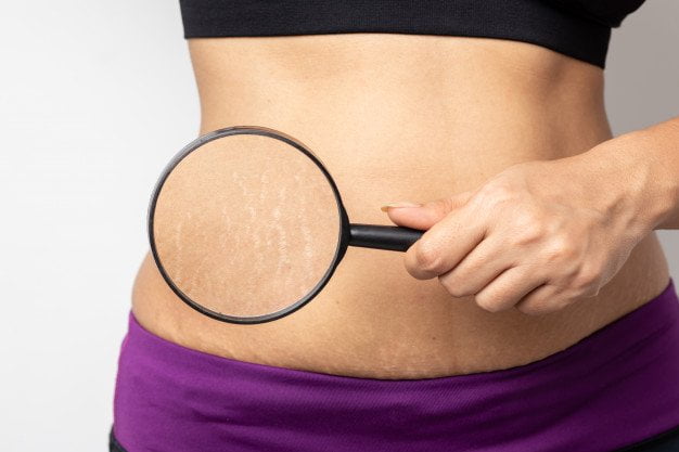 How to get rid of stretch marks with effective home remedies-illusionst.com